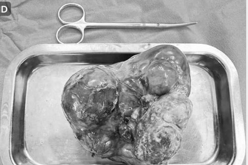 Bé trai sơ sinh đầu tiên tại Việt Nam có khối u quái 'khổng lồ' ở dạ dày hiếm gặp