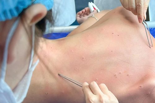 Tổ ong rơi trúng khiến bé trai bị đốt chi chít hơn 70 mũi