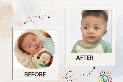 Cơ hội phẫu thuật miễn phí cho trẻ bị sứt môi