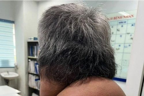 Nghiện rượu lâu năm, người đàn ông mắc bệnh hiếm gặp có khối mỡ nặng gần 2 kg