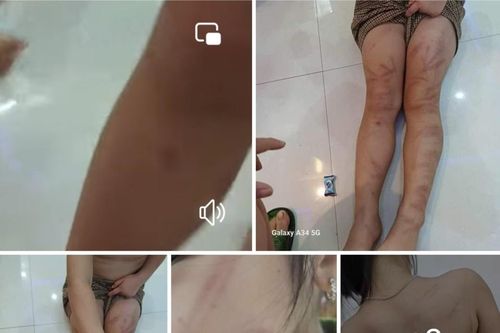 Tạm đình chỉ công tác giáo viên để 6 trẻ em bị đánh bầm tím