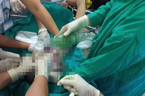 Mổ cứu thai nhi khi sản phụ ngừng tuần hoàn, ngừng hô hấp