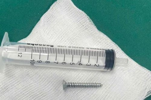 Cấp cứu thành công bé 4 tuổi nuốt sặc cây đinh vít nhọn, nguy kịch