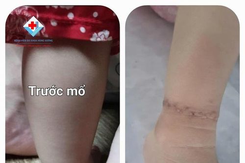 Thấy con có ngấn ở chân, bố mẹ vui mừng tưởng con bụ bẫm, nào ngờ dị tật bẩm sinh