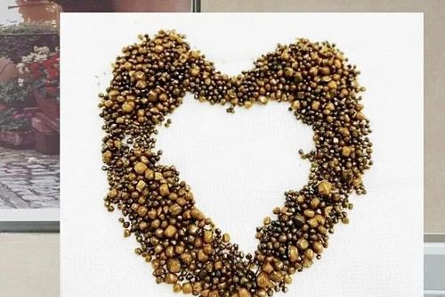 Hàng trăm viên sỏi trong túi mật