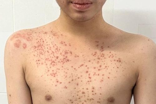 Mua thuốc trên mạng bôi chữa ngứa, thanh niên nhiễm nấm đầy người