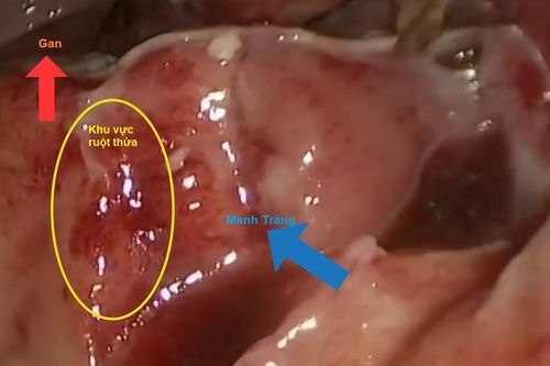 Đau bụng âm ỉ, đau bụng quanh rốn cảnh giác với viêm ruột thừa