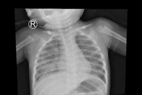 TP.HCM: Bé trai 1 tuổi viêm phổi vì uống nhầm dầu hương liệu