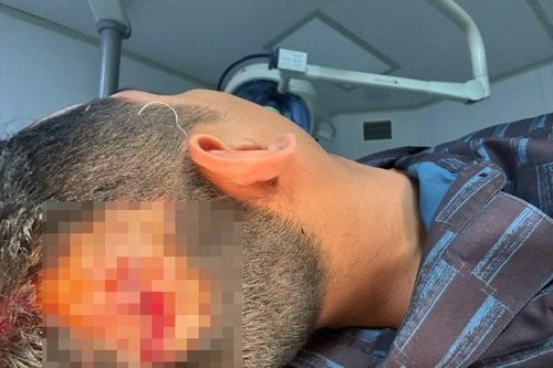 Vụ người dân bị đánh bất tỉnh khi đi ăn đêm: Công an kết luận nạn nhân bị đánh vào vùng đầu bằng vật tày có cạnh