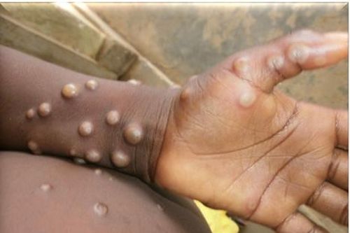 Canada xác nhận trường hợp đầu tiên nhiễm virus đậu mùa khỉ nhóm Ib