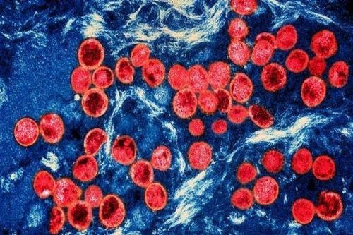 Canada xác nhận ca đầu tiên mắc đậu mùa khỉ chủng clade I