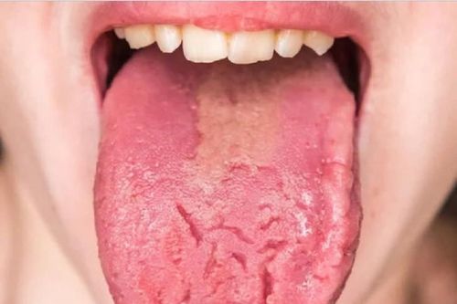 Dấu hiệu khác lạ ở lưỡi cảnh báo những bệnh nguy hiểm
