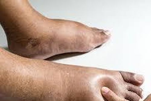 Phù chân là do những nguyên nhân nào gây ra?