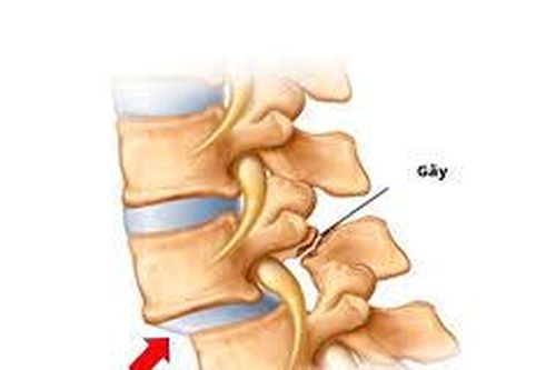 Phẫu thuật trượt cột sống thắt lưng ở người cao tuổi có hiệu quả không?