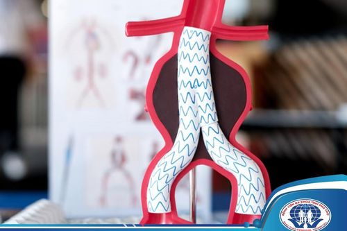 Đặt stent graft - Thủ thuật xâm lấn tối thiểu đem lại hiệu quả vượt trội