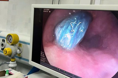 Đối tượng nuốt ma túy vào bụng để phi tang khi gặp công an