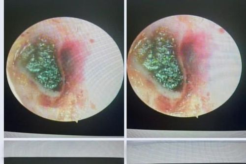 Người đàn ông đau nhức, phải đến viện do sai lầm nhiều người hay mắc khi lấy ráy tai