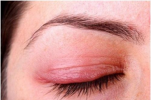Khắc phục nhược điểm khi nối mi giả