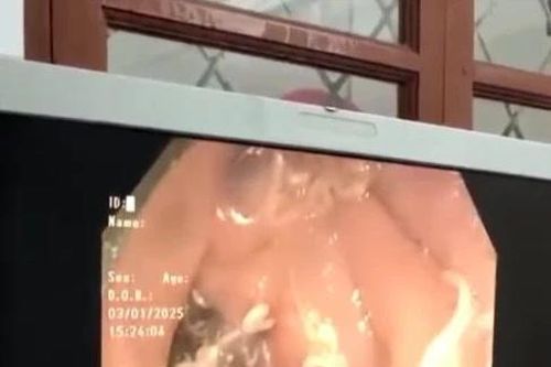 Kinh hãi khi hàng trăm con giun bám trắng ruột người phụ nữ