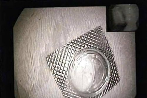 Gắp viên thuốc còn nguyên vỏ sắc nhọn kẹt trong thực quản nữ bệnh nhân