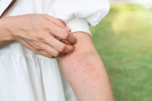 Dị ứng thức ăn ngày Tết cần biết để tránh rủi ro