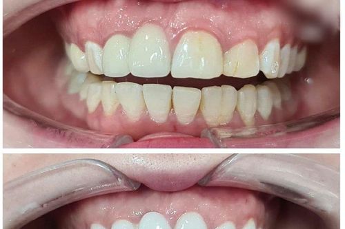 Những lưu ý khi bọc răng sứ
