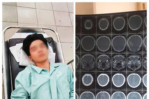 Vụ nam sinh bị hành hung nứt sọ não: Nghi do mâu thuẫn tình cảm