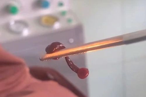 Gắp thành công con vắt dài 3 cm sống trong mũi người đàn ông