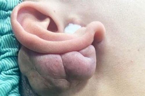 Giải cứu vành tai cho nam thanh niên 22 tuổi mắc ung thư
