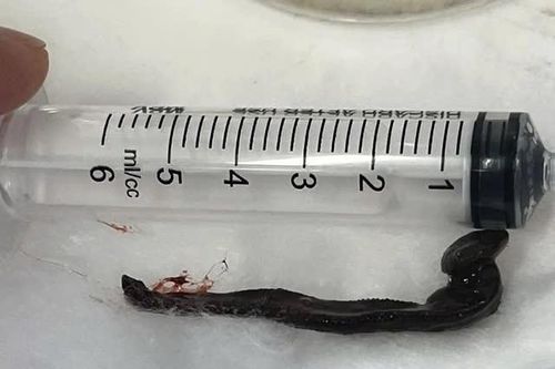 Phát hiện con vắt dài hơn 6 cm sống trong mũi bệnh nhân