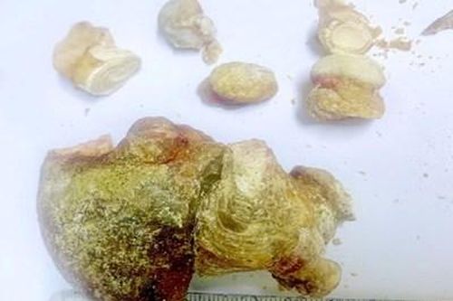 Phẫu thuật lấy khối sỏi san hô lớn ở thận của bệnh nhân 70 tuổi