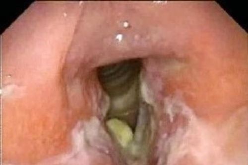Thuốc điều trị lao thanh quản