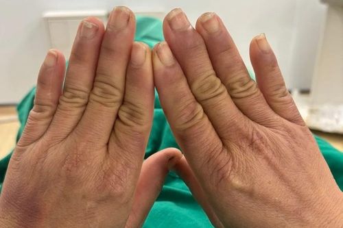 Điều trị chứng đau tay khi chạm vào nước