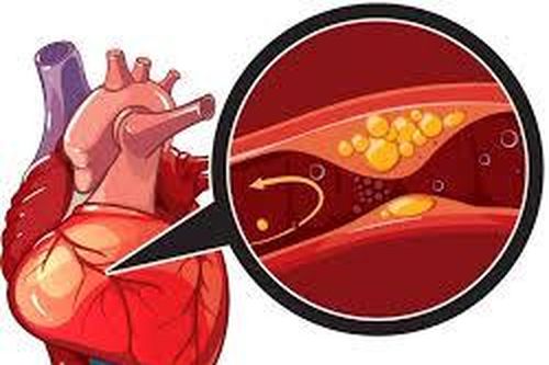 Thiếu máu cơ tim, hẹp động mạch vành có chơi thể thao được không?