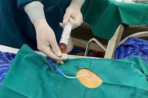 Cứu sống cụ ông tràn dịch màng ngoài tim do lao biến chứng