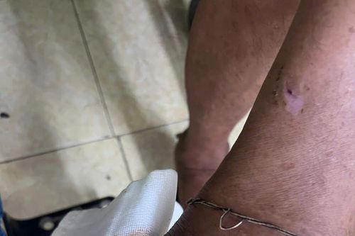 Biến chứng uốn ván toàn thể do tự ý sử dụng thuốc nam truyền miệng