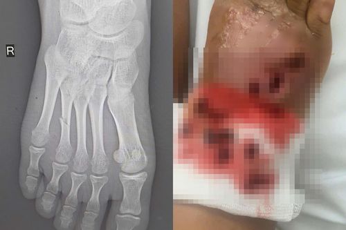 Bé gái suýt mất chân vì bó thuốc nam chữa gãy xương tại nhà