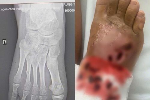 Hoại tử nhiễm trùng nặng do bó thuốc nam điều trị gãy xương