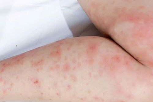 Cảnh báo gia tăng các bệnh về da trong mùa mưa