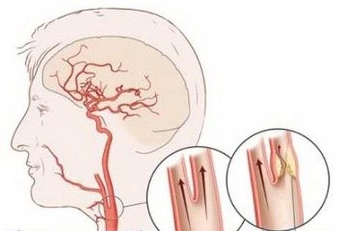 Đột ngột ngất xỉu khi đang ăn cơm do tắc động mạch cảnh