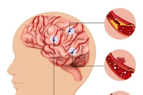 Hướng dẫn xử lý đúng khi người thân tai biến mạch máu não
