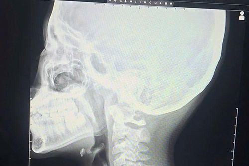 Nội soi gắp thành công mảnh xương gà dài 3cm cho bé trai 12 tuổi