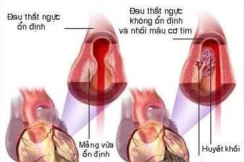 Đau thắt ngực cẩn thận nhồi máu cơ tim