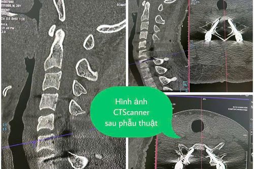 Phẫu thuật thành công cho người nước ngoài bị chấn thương cột sống cổ nặng