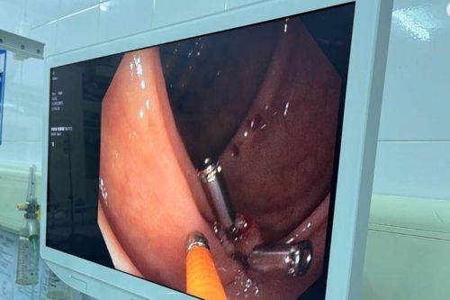 Cứu người bệnh nguy kịch do chảy máu đại tràng
