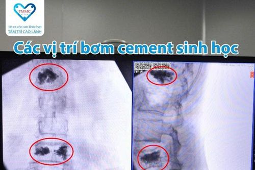 Điều trị thành công gãy xẹp hai đốt sống bằng kỹ thuật tạo hình thân đốt sống bơm cement sinh học qua da tại Bệnh viện Tâm Trí Cao Lãnh