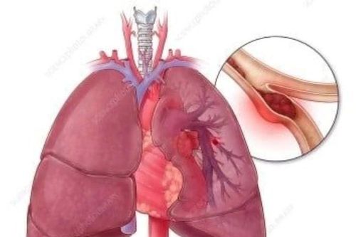 Dùng thuốc tránh thai kéo dài, người phụ nữ bị thuyên tắc phổi nguy kịch