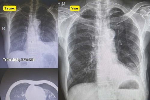 Sau 2 ngày ngã, cụ ông 96 tuổi nguy kịch vì tràn máu phổi, gãy 4 xương sườn