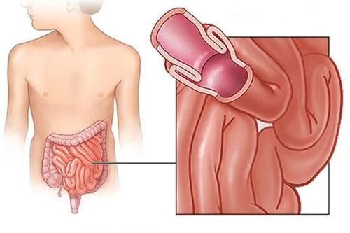 Lồng ruột trẻ em, phát hiện điều trị sớm để bảo vệ tính mạng