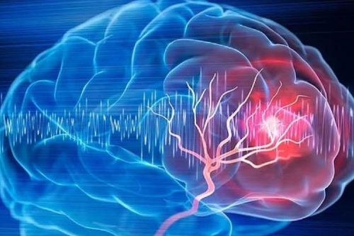 Người phụ nữ 57 tuổi bất ngờ phát hiện khối u não nhờ đồng hồ đeo tay